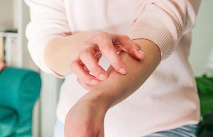 Atopic eczema, let’s dare to talk about it!