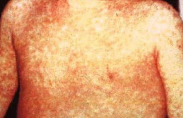 Alberta ripples the response against measles