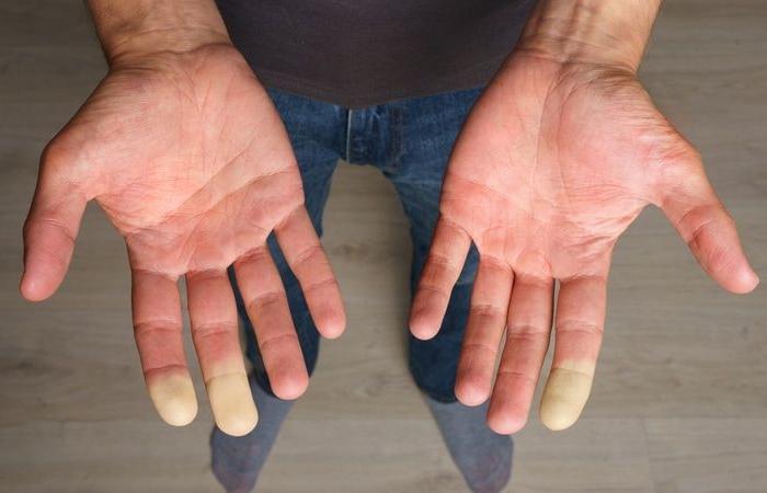 Use your smartphone to assess the severity of Raynaud’s syndrome