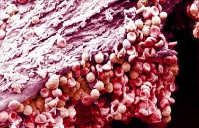 Towards a lightened antithrombotic prophylaxis in cancer | The doctor’s daily life | Specialties