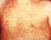Alberta ripples the response against measles