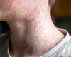 Measles epidemic: Canada could lose its status to eliminate the disease