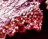 Towards a lightened antithrombotic prophylaxis in cancer | The doctor’s daily life | Specialties