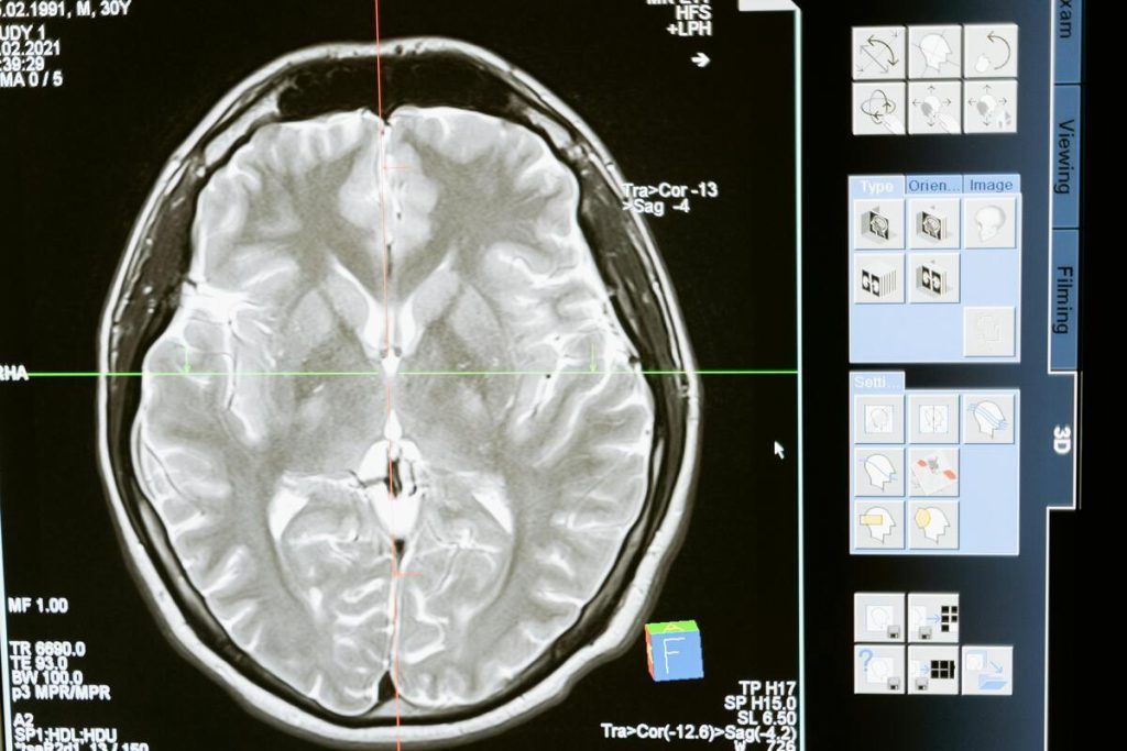 Multiple Sclerosis: These 5 Warning Signs, According to Researchers