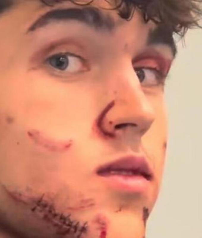 kick in the face, bloody cut and 10 stitches