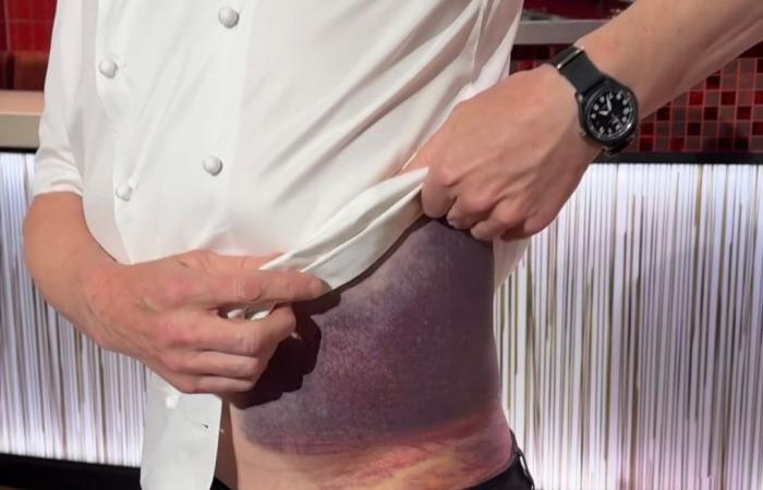 ‘I’m lucky to be here’…Chef Gordon Ramsay shows off his impressive injury after a bike fall