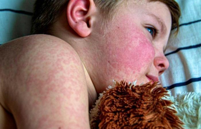 Health in Luxembourg: The fifth disease, more surprising than “serious”