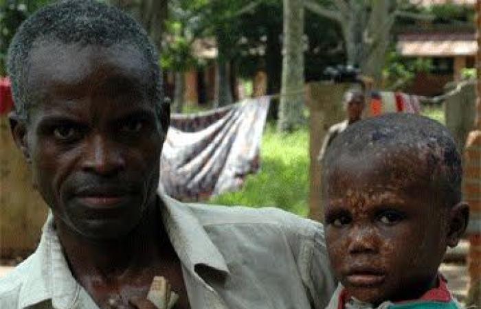 Monkeypox declared in North Kivu