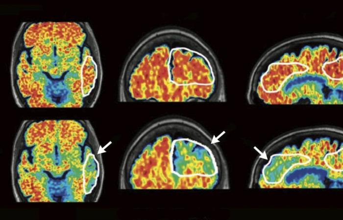 Waiting for lecanémab, a drug that slows the progression of Alzheimer’s