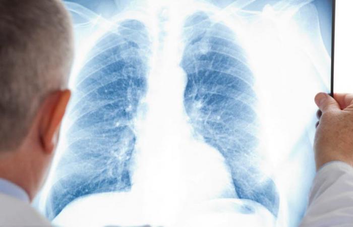 why are they also affected by lung cancer?
