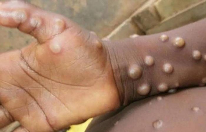 New strain of smallpox in DRC: The threat is growing