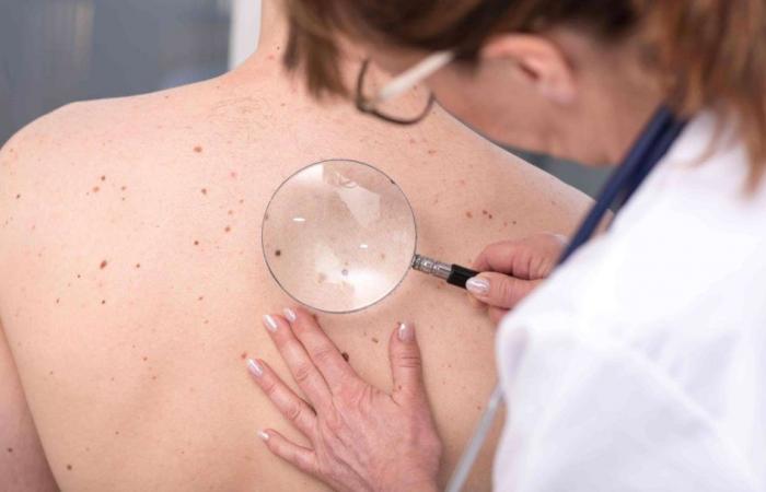How to recognize the first signs of skin cancer?