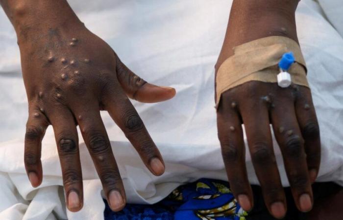 India
      confirms
      case
      of
      mpox
      but
      with
      less
      dangerous
      variant