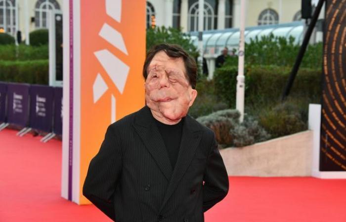 What
      is
      neurofibromatosis,
      the
      disease
      that
      actor
      Adam
      Pearson
      suffers
      from?