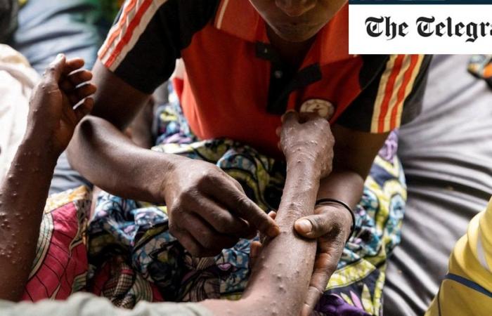 More
      than
      100
      people
      die
      from
      mpox
      in
      one
      week
      as
      outbreak
      spirals
      across
      Africa