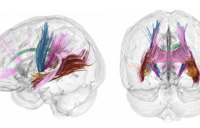 Gray Matter Regression, Better Connections: How Motherhood Reshapes the Brain