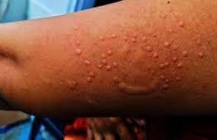 Burundi: Children most affected by Mpox (UNICEF) | APAnews