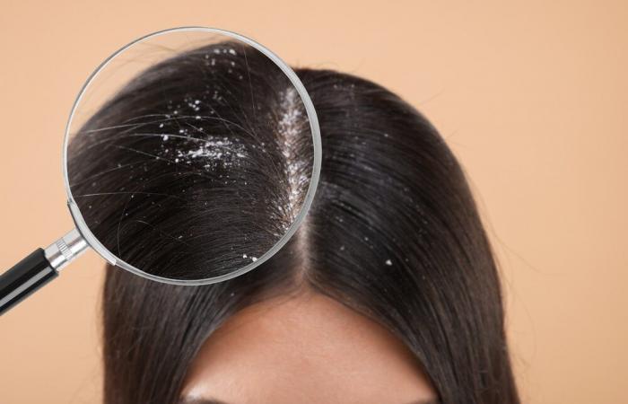 Having dandruff could increase the risk of breast cancer