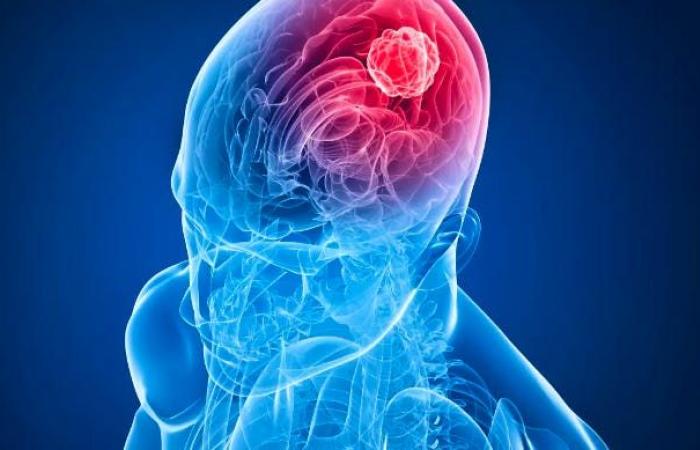 A first step towards treating brain tumors