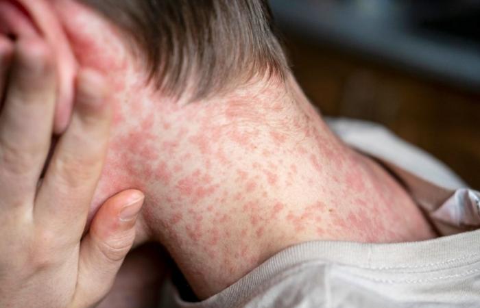 Measles: 11 cases reported in Millau, the ARS calls for vigilance