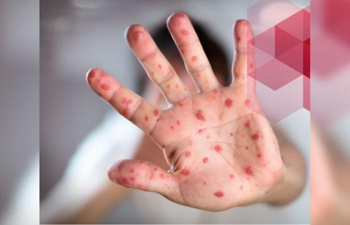 ARS Occitanie warns of 11 cases of measles in Millau “the majority of cases are not vaccinated”