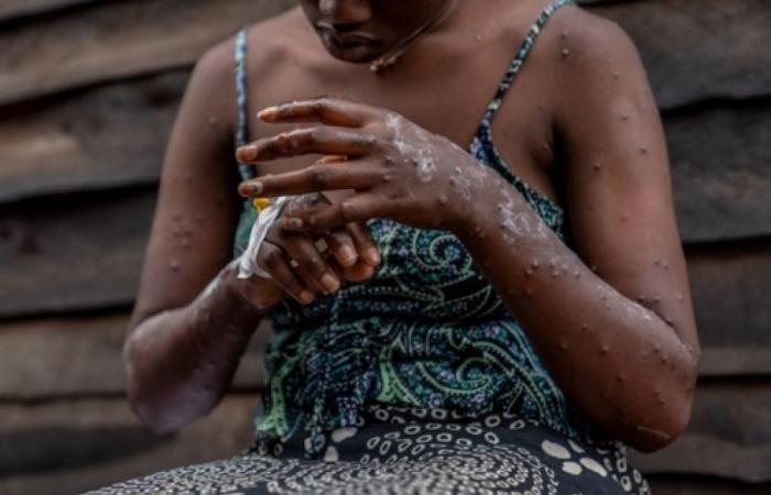 At least 866 deaths from Mpox in Africa since the start of the year