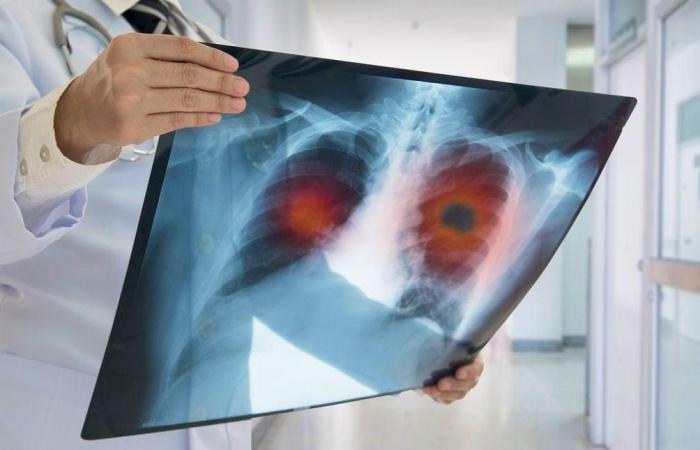 Health: The radical solution to reduce lung cancer mortality