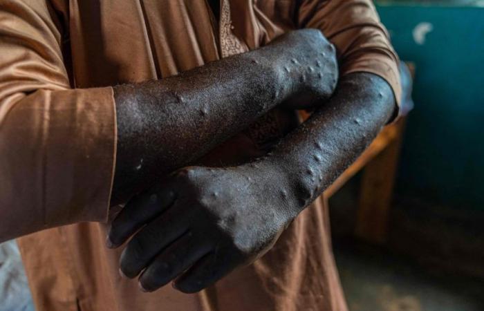 Monkey pox in Africa: 866 deaths since the start of the year