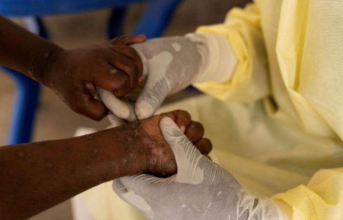 Mpox: 866 deaths from the epidemic since the start of the year on the African continent