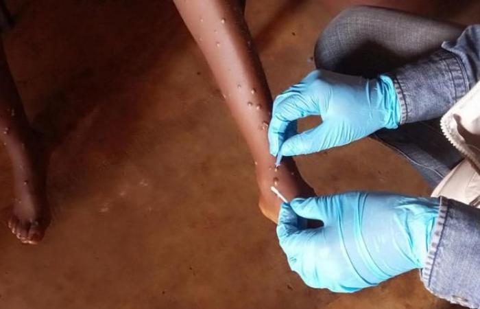 Mpox: WHO approves first diagnostic test for use in emergency situations