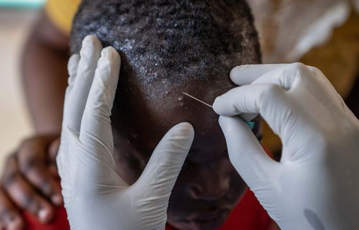 Africa: 866 deaths from monkeypox since the start of 2024