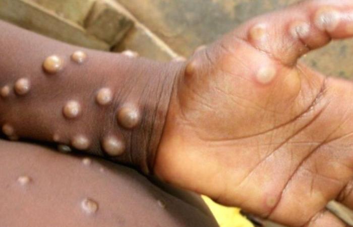 Monkey pox: after Ivory Coast, another country of…