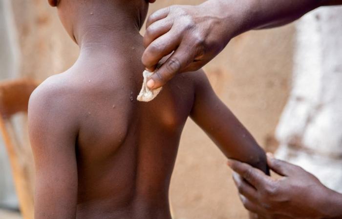 Stigma adds to Burundi’s challenges in fighting smallpox