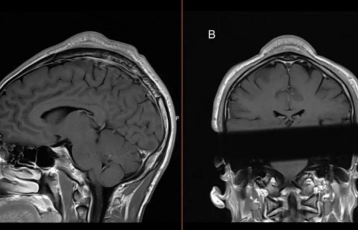 This is the tumor you can develop if you play this sport, according to a study