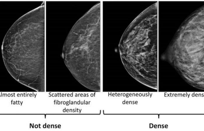 Dense breasts can make it harder to detect cancer