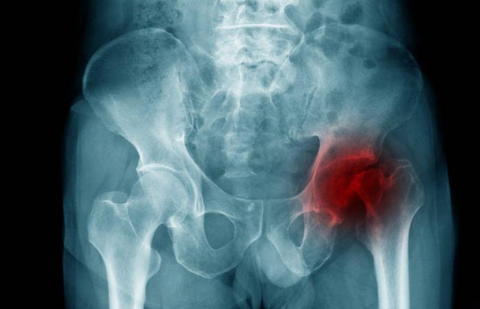 Hip fracture: how to better manage the pain?