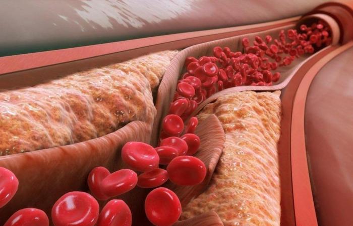 New nanoparticle therapy cleans arteries from the inside out