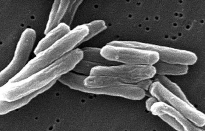 Sharp increase in the number of tuberculosis cases in Quebec