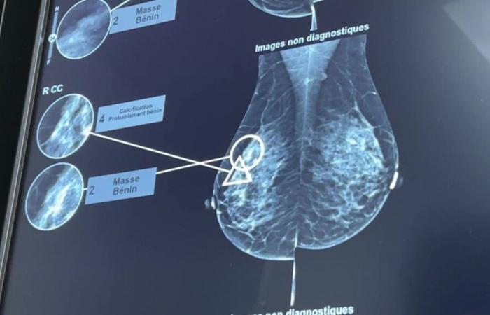 VIDEO – Breast cancer: AI, radiologists’ new weapon against the disease