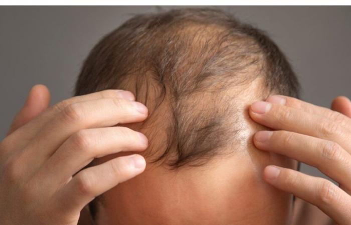 medication for baldness, prostate problems with serious side effects