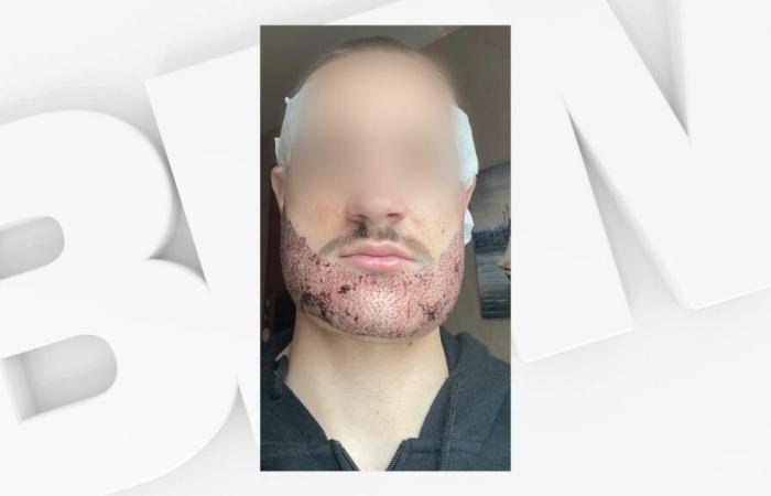 student commits suicide after failed beard transplant in Türkiye