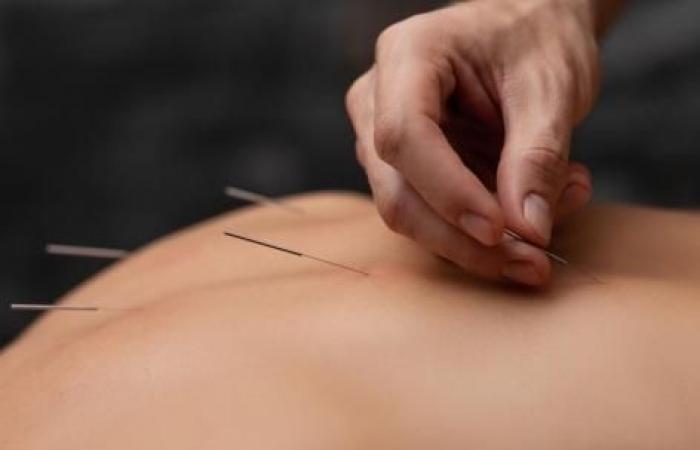 Acupuncture Reduces Pain of Chronic Sciatica Due to Herniated Disc