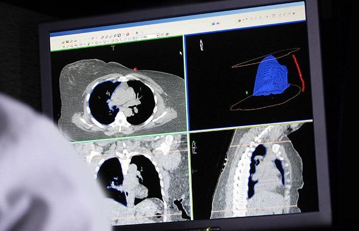 Can we simplify the lung cancer screening strategy?