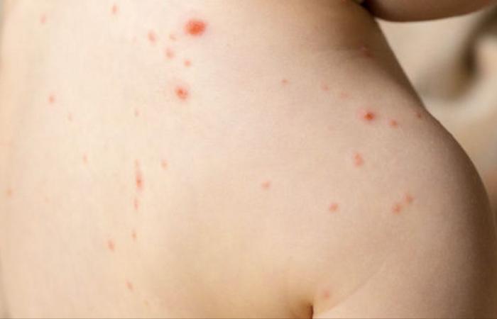 Measles outbreak in Fredericton area