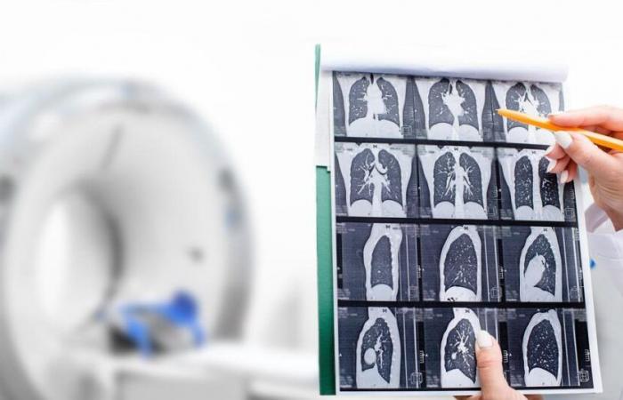 Lung cancer screening: is France delaying too much?