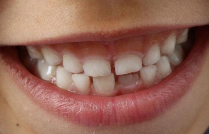 What is MIH, this disease that destroys the enamel of children’s teeth and promotes cavities?