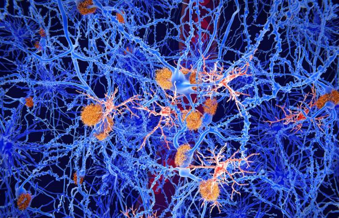 New criteria to avoid overdiagnosis of Alzheimer’s disease