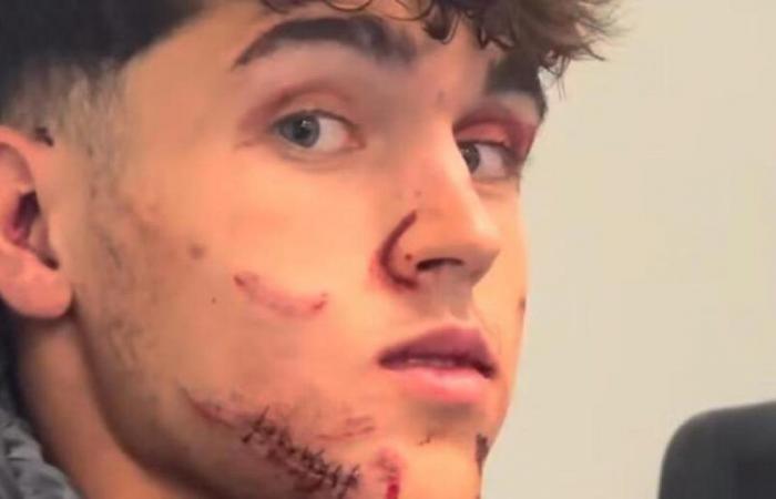 kick in the face, bloody cut and 10 stitches