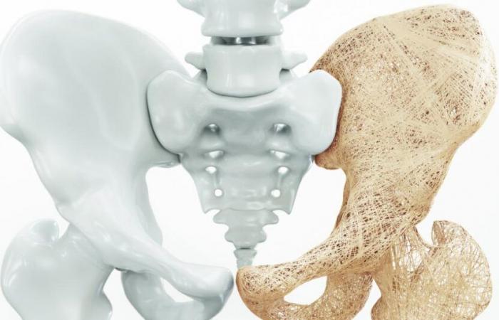 Osteoporosis screening in 4 questions