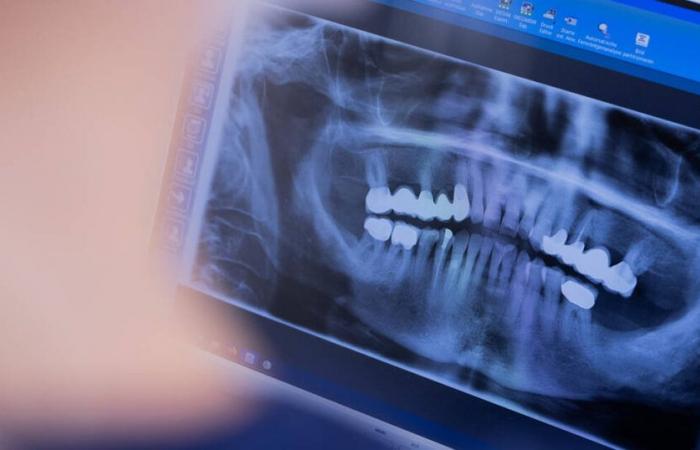 Will dental implants soon be reimbursed in France? – Liberation